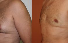 antes y después de ginecomastia