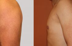 antes y después de ginecomastia