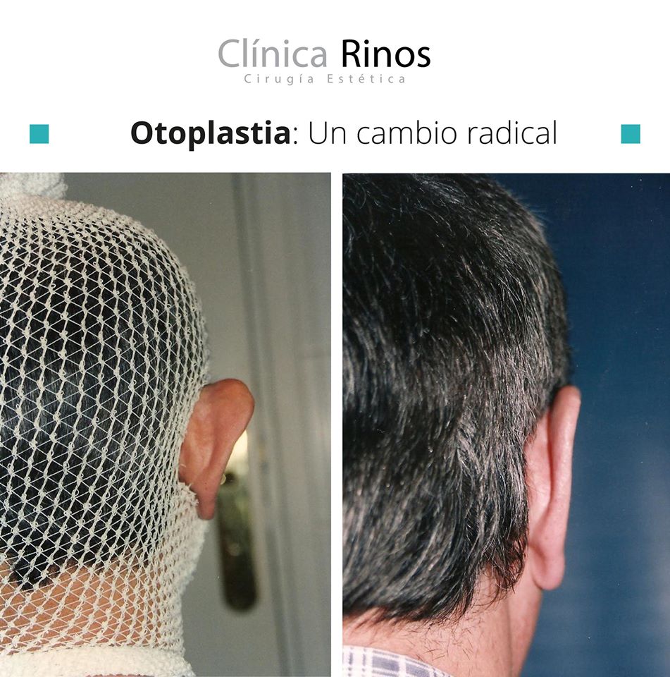 Otoplastia Girona. Antes y después.